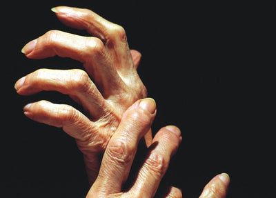 Five Common Sources of Arthritis Pain