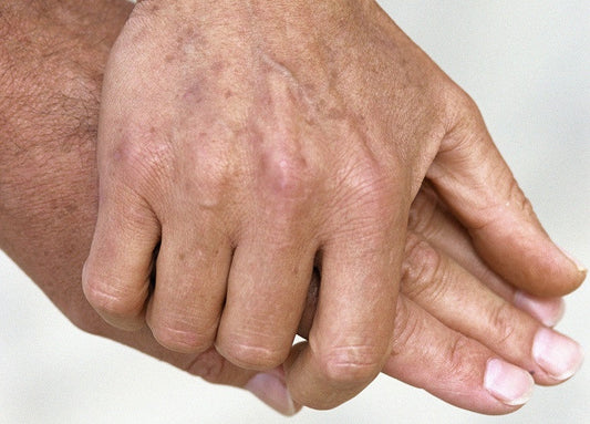 Close-up of a hand with a bruise