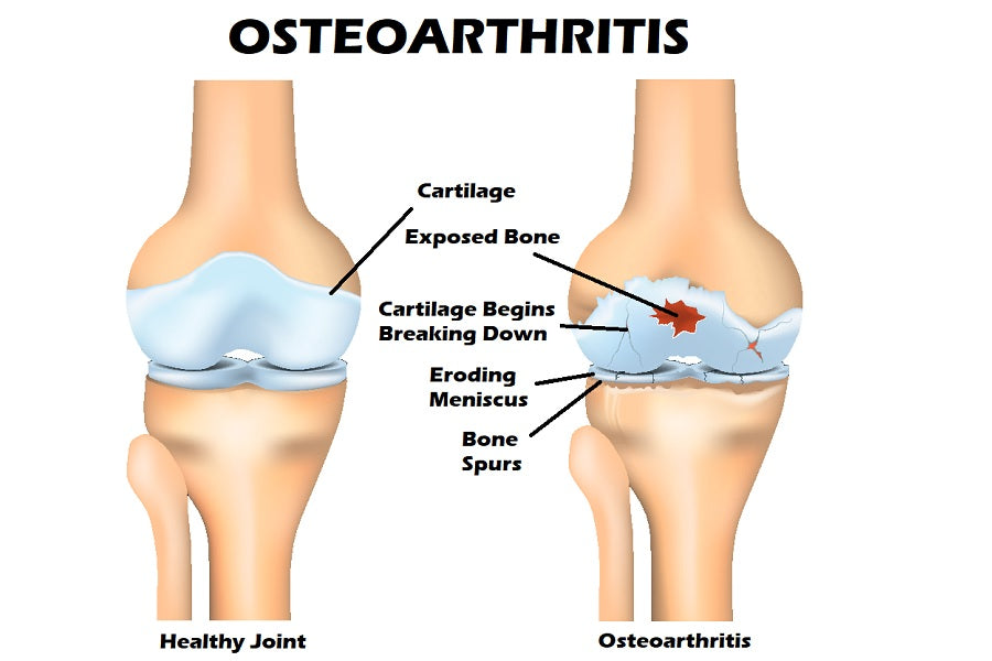 Breaking Health News: Symptoms of Osteoarthritis