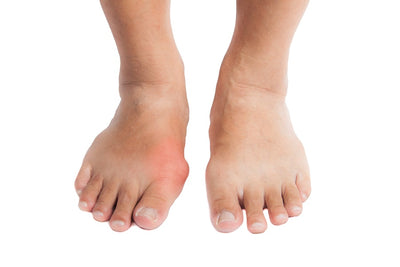 Dangers of Gout