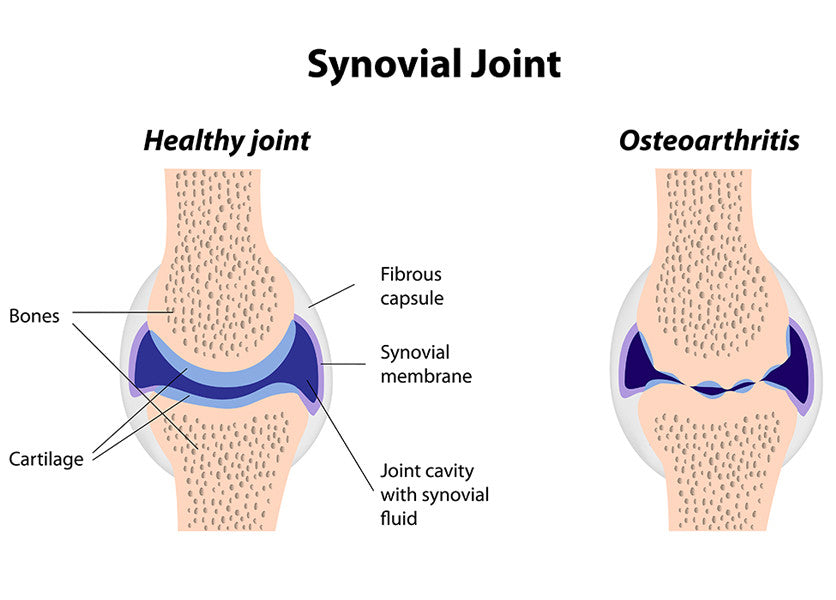 Osteoarthritis