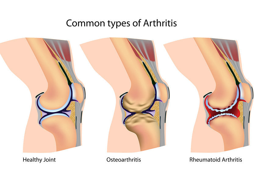 Hands showing joint swelling and pain from rheumatoid arthritis