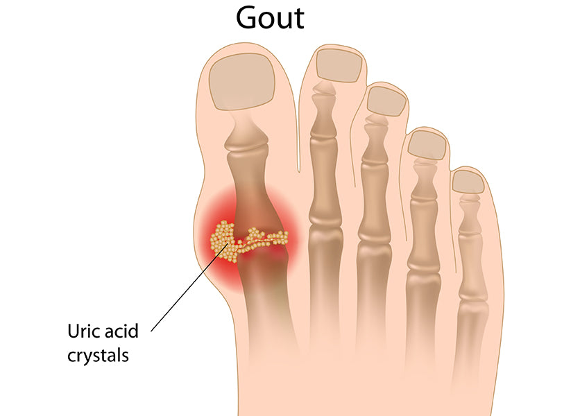 Gout