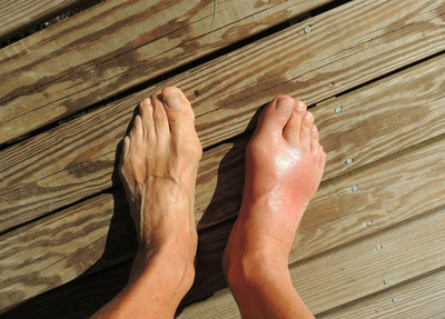 Simple Health Tips for Gout Sufferers